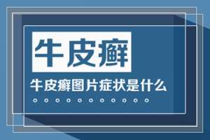 牛皮癣患者夏季能洗澡吗，怎样洗澡