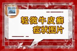 成年人身上出现牛皮癣的原因