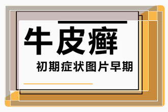 一些手上患上牛皮癣的原因有哪些